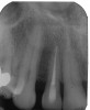Figure 2  Pretreatment peri-apical radiograph.