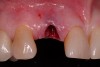 Figure 4  Atraumatic tooth removal.