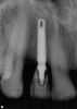Figure 17  Immediate postoperative peri-apical digital radiograph.