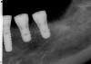 Figure 6  Computer-guided implant placement.