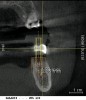 Figure 14  Cross-sectional cone-beam CT view of augmented extraction site No. 30.