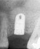 Figure 6  At site No. 14, a radiograph depicting the full "dome" of graft material apical to the implant.