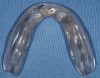 Figure 5B  A clear surgical guide fabricated by duplicating the ideal setup ensures implant placement within the confines of the final denture base.