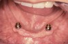 Figure 6A  An implant-retained and tissue-supported two-implant overdenture system.