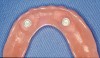 Figure 6B An implant-retained and tissue-supported two-implant overdenture system.