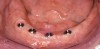 Figure 7A  Four Regular Neck implants (Straumann USA, LLC, Andover, MA) were placed anterior to the mental foramen with ideal distribution.
