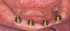 Figure 7B  Abutments (LOCATOR) were selected based on the depth of the peri-implant sulcus, which was obtained by measuring the distance from the top of the implant to the highest point of soft tissue (eg, transmucosal cuff heights of 1 mm to 6 mm were available).