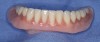 Figure 7I  The prosthesis after being polished and having the occlusion checked; it is ready for final delivery and hygiene instruction.