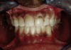 Figure 4  Final composite restorations with respect to upper right incisors.