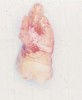 Figure 1a  Tooth No. 3 was extracted. At the time of extraction, it was noted that a portion of the buccal alveolar plate was attached to the roots of the tooth.