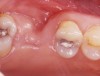 Figure 1b  Occlusal view of the alveolar ridge after extraction of tooth No. 3. This site will require ridge augmentation before placement of a dental implant–supported restoration.
