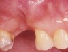 Figure 1c  Buccal view of the alveolar ridge after extraction of tooth No. 3.