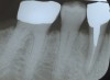 Figure 2a  A periapical radiograph of the tooth revealed the presence of a radiolucent appearance that was more significant at the midroot level. A root fracture was evident after flap elevation.