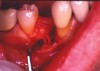 Figure 2b  After extraction of the tooth, the socket was curetted. It was noted that there was bone loss on the buccal aspect because of the presence of infected tissue.