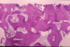 Figure 2d  The histology report included the presence of viable bone consisting of anastomosing trabeculae surrounding Haversian systems