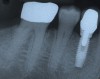 Figure 2f: Implant placement was completed uneventfully, and after a healing period of about 3 months the implant was restored.