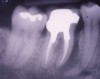 Figure 3a  Tooth No. 30 presented with a fractured root deemed nonrestorable.