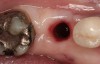 Figure 4  The site following atraumatic implant removal.