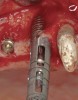 Figure 12  Trephine bur used to remove bone around the failed implant guided by the implant mount.
