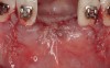 Figure 10  Primary wound closure was achieved; the patient subsequently presented to the orthodontist to replace the archwire; two denture teeth were attached to brackets for esthetic purposes.