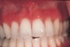 Figure 1  Diffuse erythematous gingiva of upper arch (Case 16).