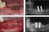 Figure 2   rhPDGF promotes extensive vertical and lateral bone formation in a large, chronic critical sized alveolar ridge defect (3cm long x 7 mm to10 mm deep x the entire width of the mandible) model in canines. The upper panels (2A and 2B) represent the clinical and radiographic out- comes 4 months after treatment using an earlier standard of care consisting of a guided bone regeneration (GBR) procedure that utilized a deproteinized bovine bone block covered by a cell occlusive collagen membrane. Virtually no vertical bone augmentation was achieved. The lower panels (2C and 2D) represent the clinical reentry and radiographic results 4 months following treatment using rhPDGF infused in the deproteinized bovine block without a membrane. High quality dense bone was regenerated throughout the defect, both vertically and horizontally.30