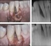 Figure 4  Severe bone defect extending nearly to the tooth root apex (4A and 4B) treated with rhPDGF and mineralized bone allograft. Surgical reentry and radiograph 11 months later shows nearly complete bone fill (4C and 4D).