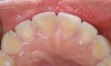 Figure 4  A patient with history of bulimia has dental erosion on the lingual surfaces of her maxillary incisors.