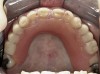 Figure 2  Intraoral occlusal view of maxillary dentition with the existing removable prosthesis presenting excessive signs of wear.