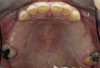 Figure 4  Intraoral occlusal view of maxillary dentition presenting excessive signs of wear.