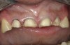 Figure 11  Tooth preparations. Anterior view.