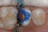 Figure 17  Phosphoric acid (30% to 40%) is ringed on the enamel first for 15 seconds and then run into the tooth for approximately another 10 seconds. It is then washed out, the tooth is briefly dried, and the restoration is finished using primers and adhesives.