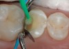 Figure 19  Phosphoric acid (30% to 40%) is ringed on the enamel first for 15 seconds and then run into the tooth for approximately another 10 seconds. It is then washed out, the tooth is briefly dried, and the restoration is finished using primers and adhesives.
