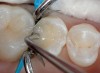 Figure 20  Phosphoric acid (30% to 40%) is ringed on the enamel first for 15 seconds and then run into the tooth for approximately another 10 seconds. It is then washed out, the tooth is briefly dried, and the restoration is finished using primers and adhesives.