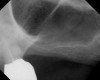 Figure 2  Buccal and radiographic views of posterior edentulism with significant sinus pneumatization in the molar region.