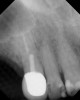 Figure 3  Buccal and radiographic views of posterior edentulism with significant sinus pneumatization in the molar region.