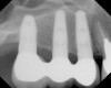 Figure 8  Radiographic confirmation of implant osteointegration into the new bone 14 months after the initial surgery.