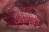 Figure 14  Particulate bone graft was applied, and simulta- neous implant placement was performed.