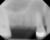 Figure 17  Preoperative radiograph showing ridge resorption.