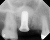 Figure 19  Radiographic view of implant placed simultaneously with sinus bone grafting in site No. 3.
