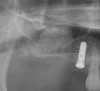 Figure 26  Bong graft was placed in the mesial and distal compartments.
