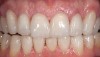 Figure 10  Postoperative photograph after Category 2 materials were applied, with minimal porcelain layering in the incisal one third.