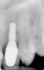 Figure 1  Radiograph demonstrating retained excess cement on abutment (see arrow).