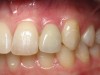 Figure 2  Clinical photograph of an implant restoration replacing the congenitally missing maxillary left lateral incisor. Note the cyanotic color changes, due to inflammation and cement, of the marginal gingiva in a 31-year-old female patient with thin biotype.