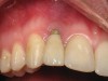 Figure 8  Clinical photograph of gingival recession resulting from excess cement around an implant crown in the maxillary right lateral incisor in a 24-year-old woman.