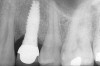 Figure 10  Radiograph demonstrating localized bone loss associated with retained cement on the mesial aspect of implant abutment. Bone loss was only noted on mesial where cement was found; no bone loss was noted on distal where cement was absent. (Actual bone loss was more evident clinically than radiographically.)