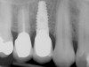 Figure 11  Radiograph demonstrating a quantity of excess cement on the mesial aspect of an implant crown and abutment.