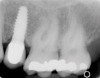 Figure 12  Radiograph demonstrating crestal bone loss around an implant collar in a 48-year-old man returning to the surgical office for a yearly examination.