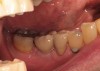 Figure 5  Final, cement-retained crown No. 30. (restorative therapy by Louis Marion, DMD)