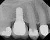 Figure 9  Radiographic appearance of restored implant.